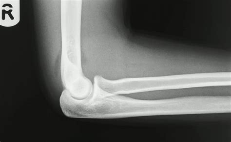 Emrad Radiologic Approach To The Pediatric Traumatic Elbow X Ray Med