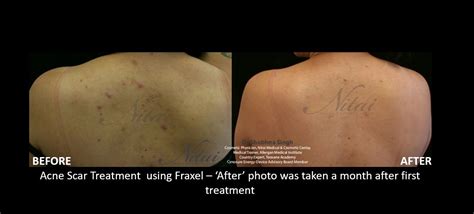 Acne Scarring Treatments Melbourne Archives Laser Skin Treatment