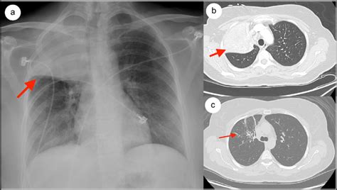 Radiologic Images A Chest X Ray Showing Dense Right Upper Lobe