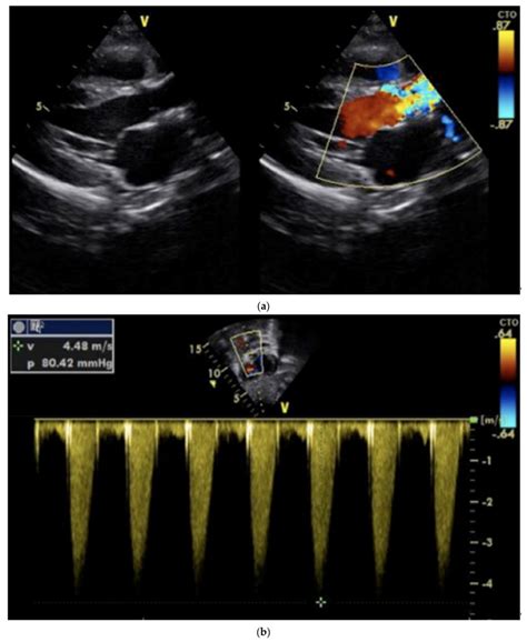 A Severe Supravalvular Aortic Stenosis Color Doppler Mapping Showed Download Scientific