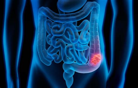 Stage 3 Colon Cancer Symptoms Diagnosis And Treatment