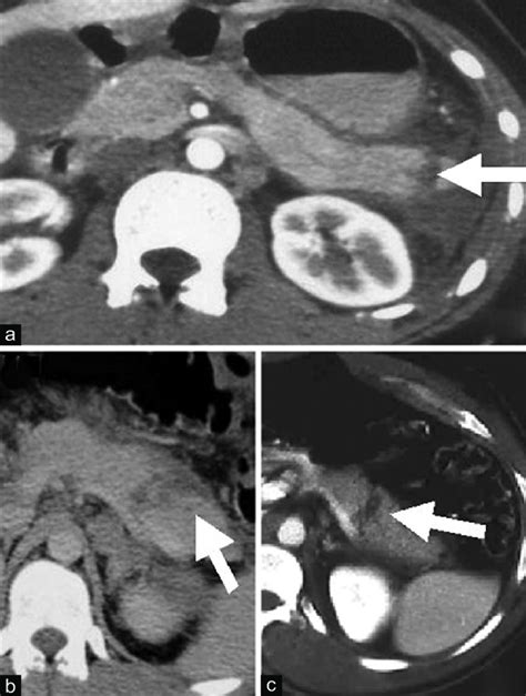 Examples Of Computed Tomography Appearance Of Traumatic Pancreatic