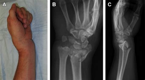 Distal Radius Fractures Musculoskeletal Key