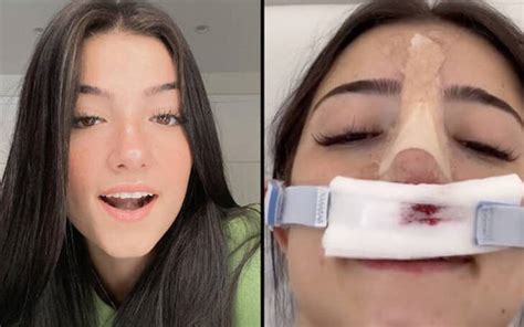 Tiktok Star Charli Damelios Plastic Surgery Did She Get A Nose Job