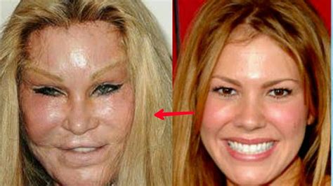The Worst Before And After Plastic Surgery