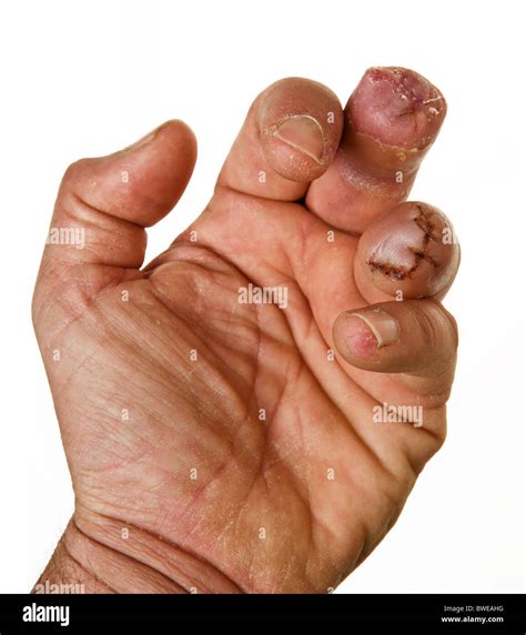 Missing Fingers High Resolution Stock Photography And Images Alamy