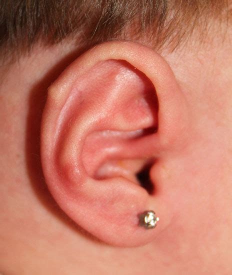Troy Ear Reshaping Before And After Photos Michigan Plastic Surgery