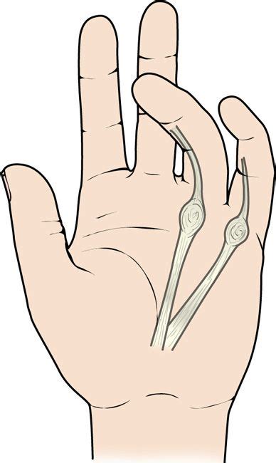 Dupuytrens Disease Orthoinfo Aaos Dupuytrens Contracture Hand
