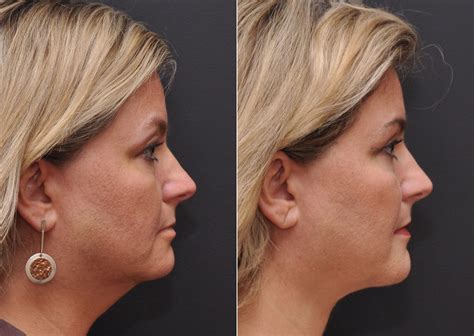 Facial Liposuction Photos Cincinnati Oh Patient 8345