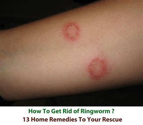 Bleach And Ringworm Does Bleach Kill Ringworm Quora It Is