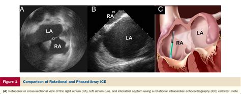 Figure 5 From The Use Of Intracardiac Echocardiography And Other