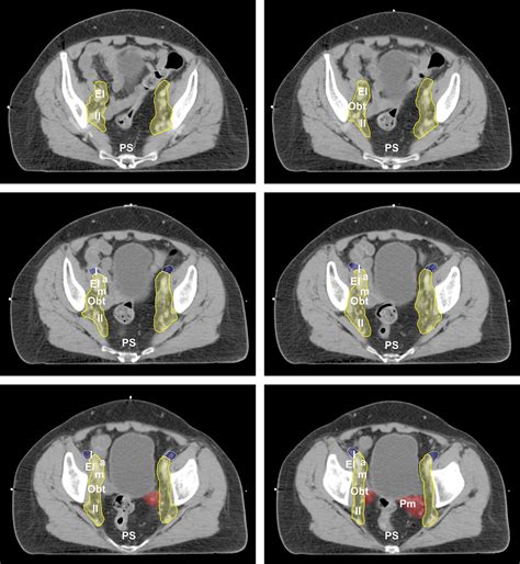 An Atlas Of The Pelvic Lymph Node Regions To Aid Radiotherapy Target