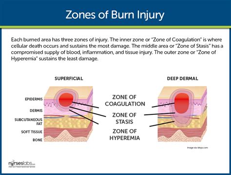 Burn Injury Nursing Care Management And Study Guide Burn Injury