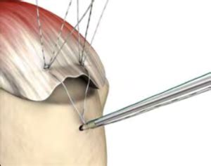 It is not a big operation to repair a torn rotator cuff, but the rehabilitation time can be long depending on the size of the tear and the quality of the tendons/muscles. Rotator Cuff Repair - Larson Sports and Orthopaedics
