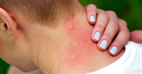 Qué hacer si le tienes alergia a las picaduras de insectos