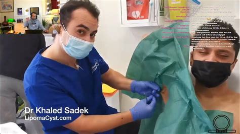 Cyst Removal Surgery Dr Khaled Sadek Youtube