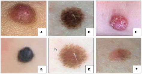 Frontiers The Spectrum Of Spitz Melanocytic Lesions From Morphologic