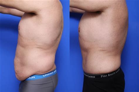 Tummy Tuck Before And After Khaleej Mag News And Stories From