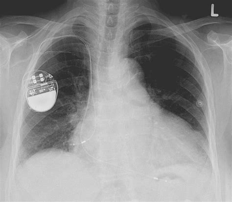 Pacemaker Implantation Procedure Dr David Begley Consultant