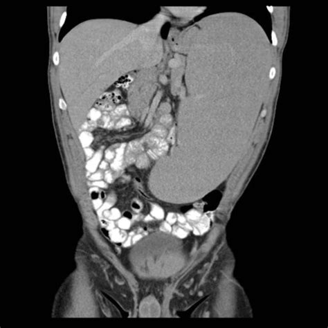 Splenomegalie DocCheck Flexikon