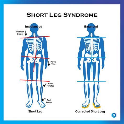 Short Limb Syndrome