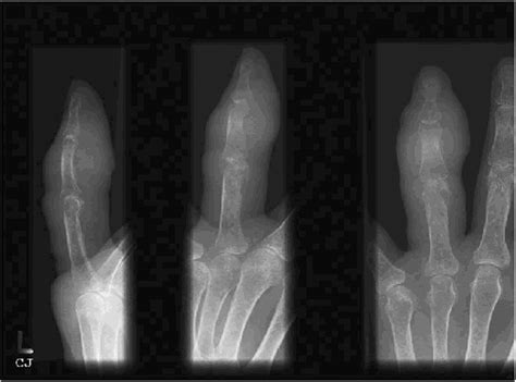 Fibro Osseous Pseudotumour Of The Digit Amputation For A Benign But