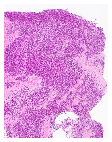 Histological Findings Of The Biopsy Specimen Of The Buttock Tumor