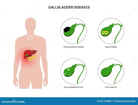 Gallbladder Diseases Poster Stock Vector Illustration Of System