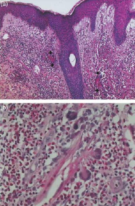 A Acute Vesicular Epidermal Spongiosis And Superficial And