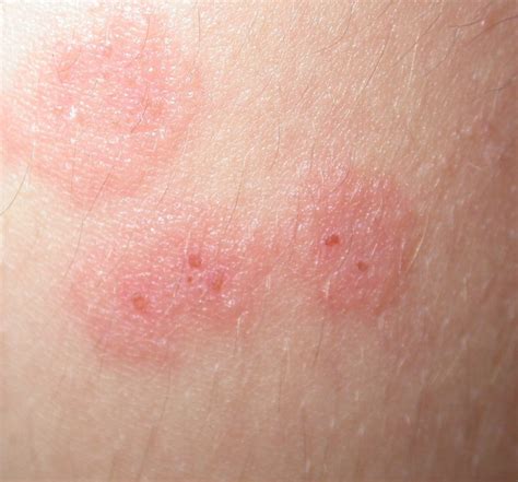 Vesicular Pityriasis Rosea An Atypical Presentation