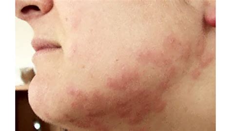 Bed Bug Rash On Face Pest Phobia