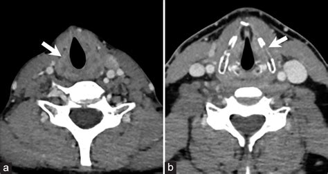 Imaging Features Of Cartilaginous Tumors Of The Head And Neck Journal