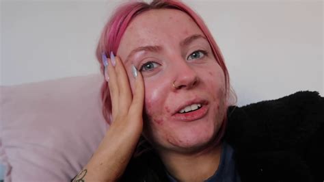 MY FIRST MONTH ON ACCUTANE SIDE EFFECTS ABBIE BULL YouTube