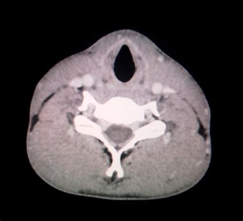 Lingual Thyroid Ct Radiology Imaging