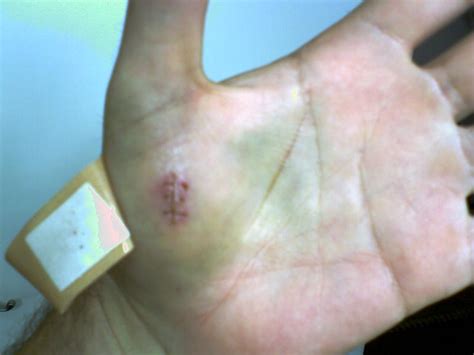 Stab Wound Pic Forums