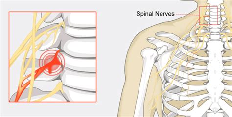 Pinched Nerve Orchard Health Clinic Osteopathy Physiotherapy And