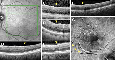 Retinal Ischemic Perivascular Lesions A Biomarker Of Cardiovascular