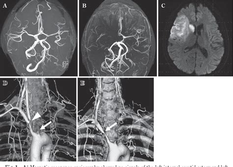 Figure From Endovascular Percutaneous Transluminal Angioplasty And