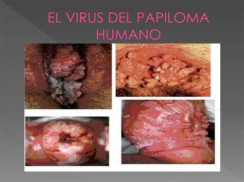 Ppt Virus Del Papiloma Humano Powerpoint Presentation Id5588566