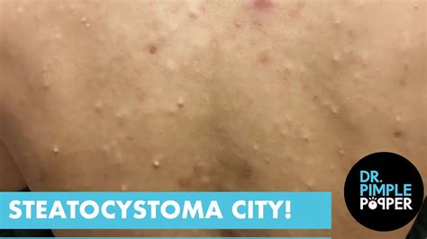 Steatocystoma City Dr Pimple Popper