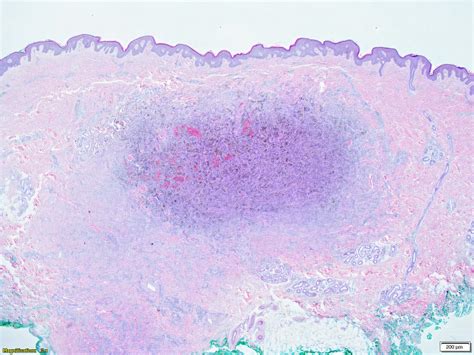 Pathology Outlines Dermatofibroma Cutaneous Fibrous Histiocytoma