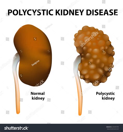 Polycystic Kidney Disease Normal And Polycystic Kidneys Stock Vector