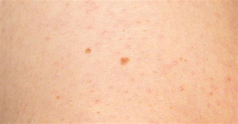 Chicken Skin What Causes It And How To Get Rid Of Those Pesky Bumps