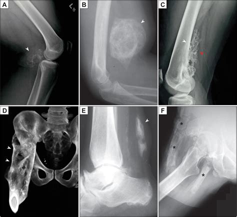 Radiographic Appearance Of Heterotopic Ossification Ho A Lateral