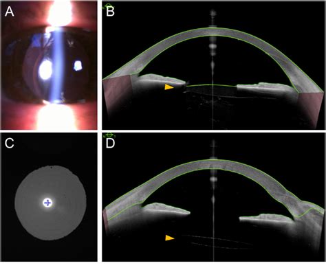 Figure 2 From Application Of A Four Flanged Intrascleral Fixation