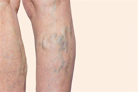 Why Does Varicose Vein Occur Atoallinks