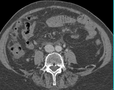 Gastric Lymphoma In Antrum With Extensive Adenopathy Stomach Case