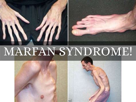 Marfan Syndrome What Is Marfan Syndrome