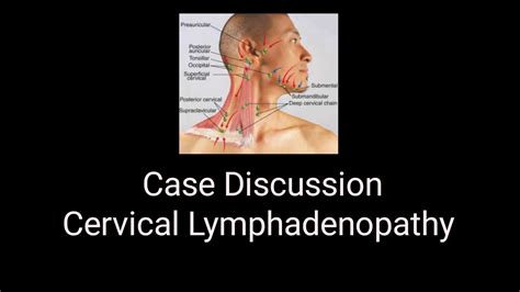 Cervical Lymphadenopathy Case Discussion Youtube