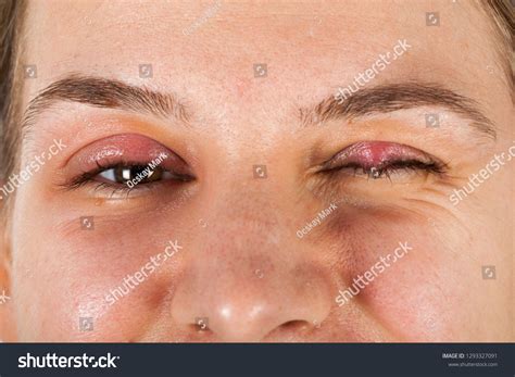 Young Female Suffering Chalazion Upper Eyelid Stock Photo 1293327091